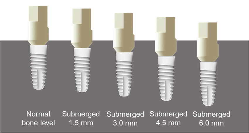 skanery implantologiczne na poziomie implantu