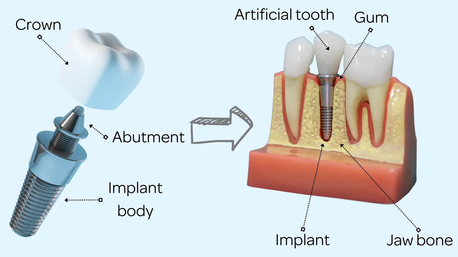 Schematic diagram of dental implant structure