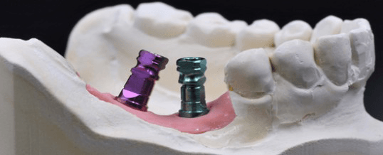 Clinical use of open-tray coping with direct seating verification